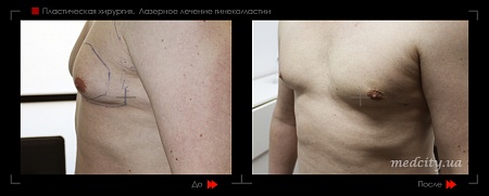 Гинекомастия 2 фото до и после процедуры