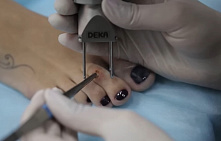 Мозоли на пальцах ног