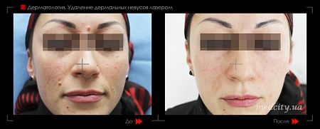 Лазерное удаление невуса 8 фото до и после процедуры