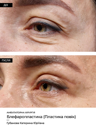 Блефаропластика фото до и после процедуры