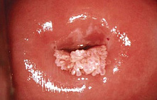 Кондиломатоз вульвы