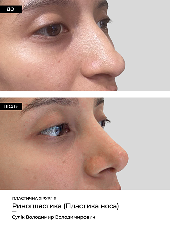 Ринопластика 9 фото до и после процедуры