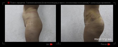 Глютеопластика (пластика ягодиц) 3 фото до и после процедуры