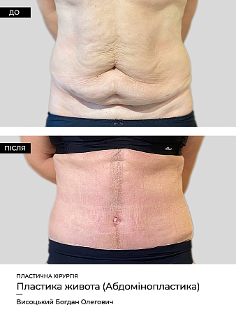 Абдоминопластика 6 фото до и после процедуры