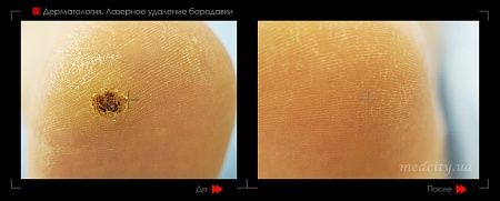 Лазерное удаление мозоля-8 фото до и после процедуры