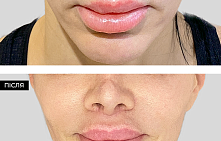 Хейлопластика (пластика губ)