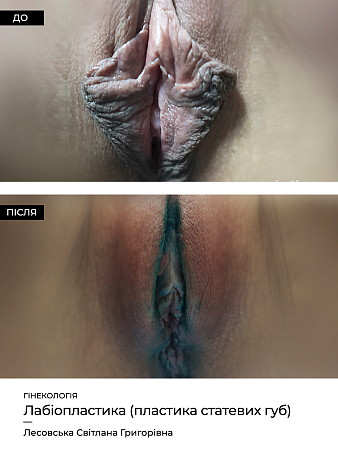 Лабиопластика (коррекция малых половых губ) фото до и после процедуры