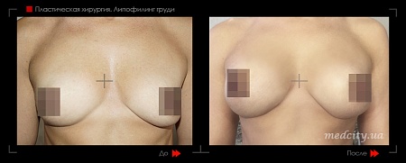 Липофилинг груди 8 фото до и после процедуры
