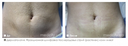 Фракционная шлифовка послеродовых стрий (растяжек) кожи живота фото до и после процедуры