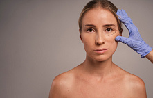 Эпикантопластика