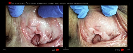 Удаление кондилом (гинек.) 9 фото до и после процедуры