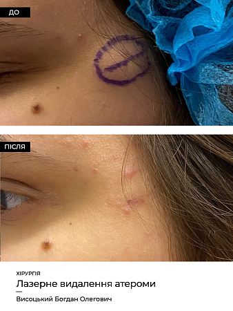 Лазерное удаление атеромы 3 фото до и после процедуры