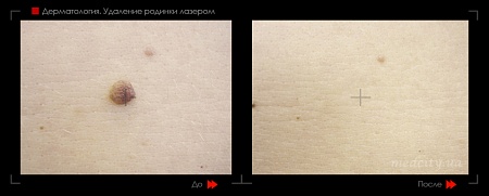 Удаление родинок12 фото до и после процедуры