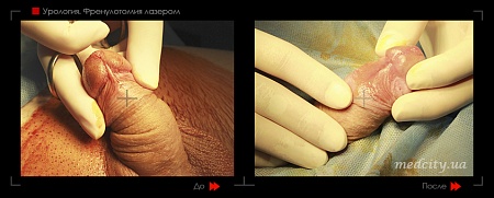 Френулотомия лазером (пластика уздечки) 12 фото до и после процедуры