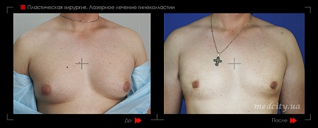 Гинекомастия 42 фото до и после процедуры