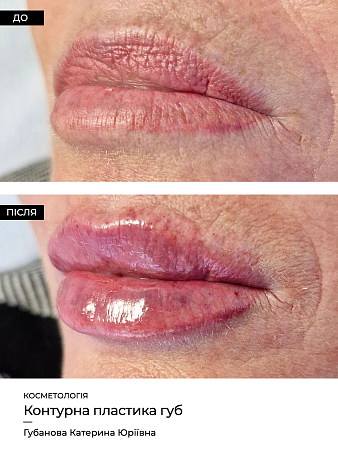Увеличение губ 30 фото до и после процедуры