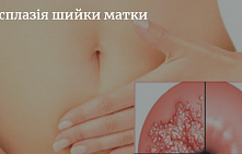 Лазерне лікування дисплазії шийки матки