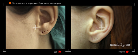 Пластика мочки уха фото до и после процедуры