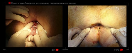 Удаление свища фото до и после процедуры