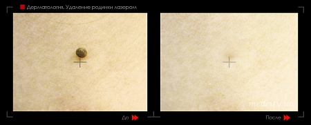 Удаление родинок 64 фото до и после процедуры