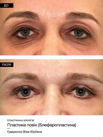 Блефаропластика нижних век фото до и после процедуры