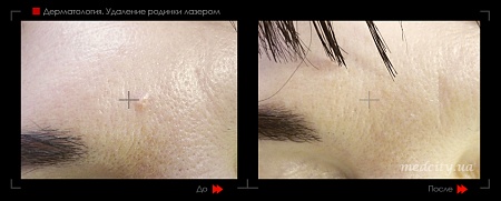 Удаление родинок 50 фото до и после процедуры