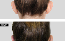 Лопоухость