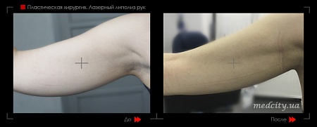 Лазерный липолиз рук 3 фото до и после процедуры
