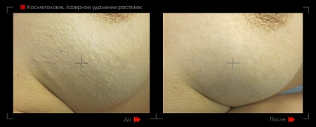Шлифовка растяжек 2 фото до и после процедуры