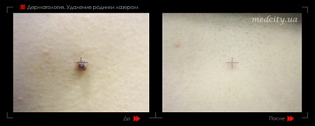 Удаление родинок 46 фото до и после процедуры