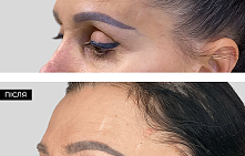 Височный лифтинг