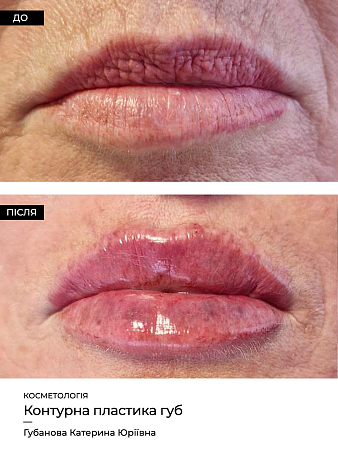 Увеличение губ 67 фото до и после процедуры