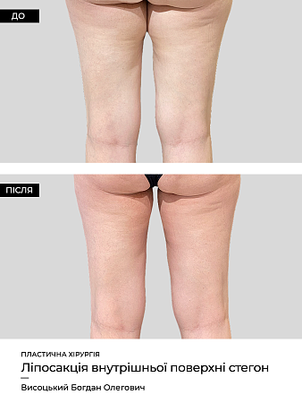 Лазерный липолиз бедер фото до и после процедуры