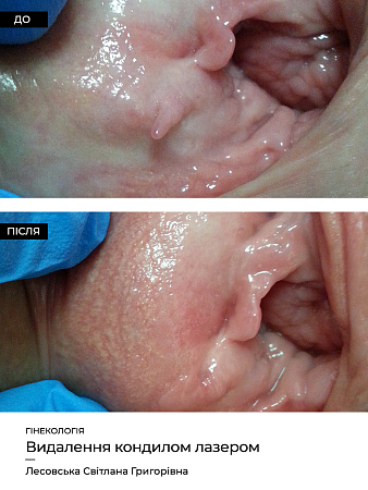 Удаление кондилом (гинек.) 8 фото до и после процедуры