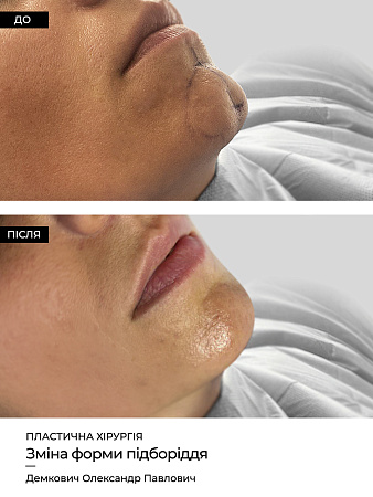 Зміна форми підборіддя фото до и после процедуры