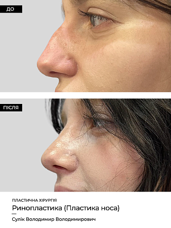 Ринопластика 18 фото до и после процедуры