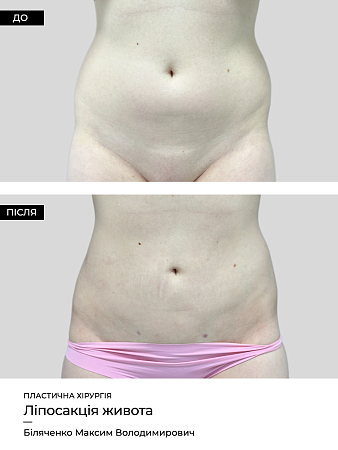 Лазерный липолиз живота 8 фото до и после процедуры