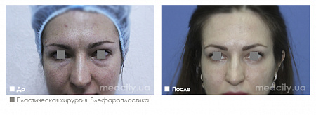 Блефаропластика фото до и после процедуры