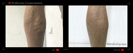 Склеротерапия 12 фото до и после процедуры