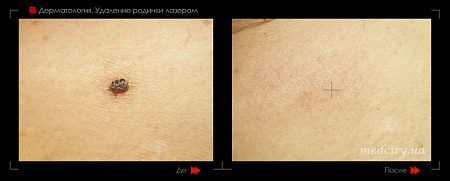 Удаление родинок 61 фото до и после процедуры
