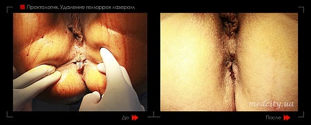 Удаление геморроя лазером 13 фото до и после процедуры