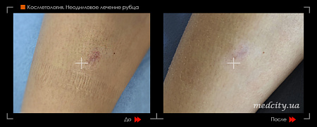 Лазерное удаление рубца фото до и после процедуры