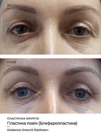Блефаропластика фото до и после процедуры