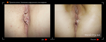 Удаление геморроя лазером (геморроидэктомия) фото до и после процедуры