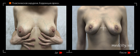 Коррекция ареол фото до и после процедуры
