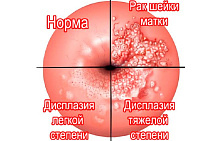 Предраковые заболевания шейки матки