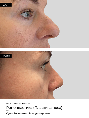 Ринопластика 21 фото до и после процедуры