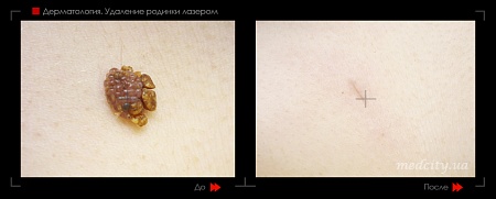 Удаление родинок 67 фото до и после процедуры