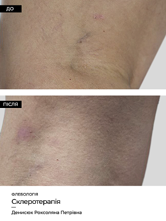 Склеротерапия 11 фото до и после процедуры