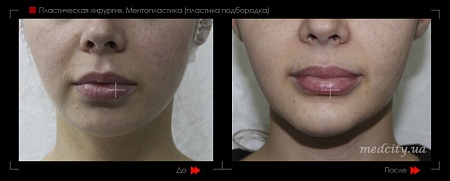 Ментопластика фото до и после процедуры